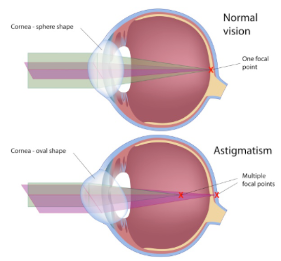 astigmatismos