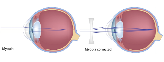 myopia