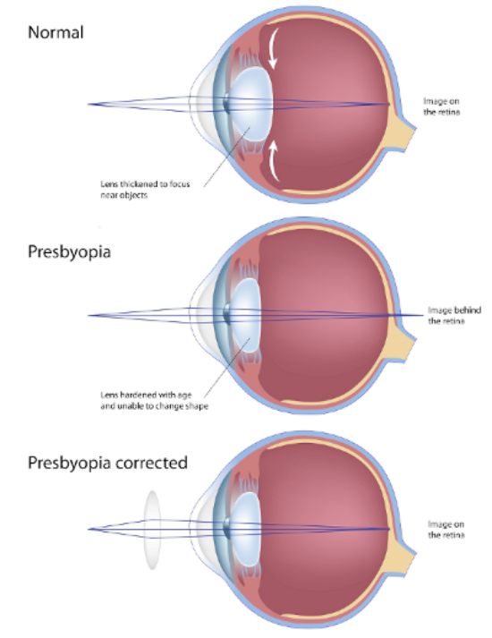 presviopia