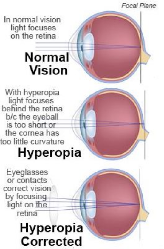 ypermetropia